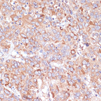 A1001, иммуногистохимия, парафиновые срезы ткани рака печени человека (2343)