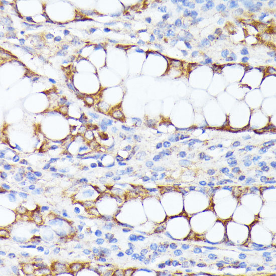 A7310, иммуногистохимия, парафиновые срезы карциномы толстой кишки человека (27306)