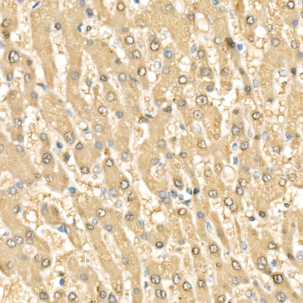 A0519, иммуногистохимия, парафиновые срезы ткани рака печени человека (2036)