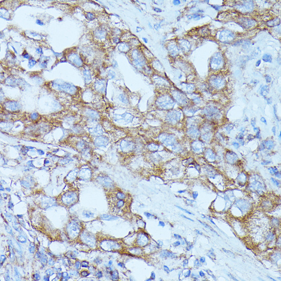 A16374, иммуногистохимия, парафиновые срезы ткани рака легкого человека (12304)