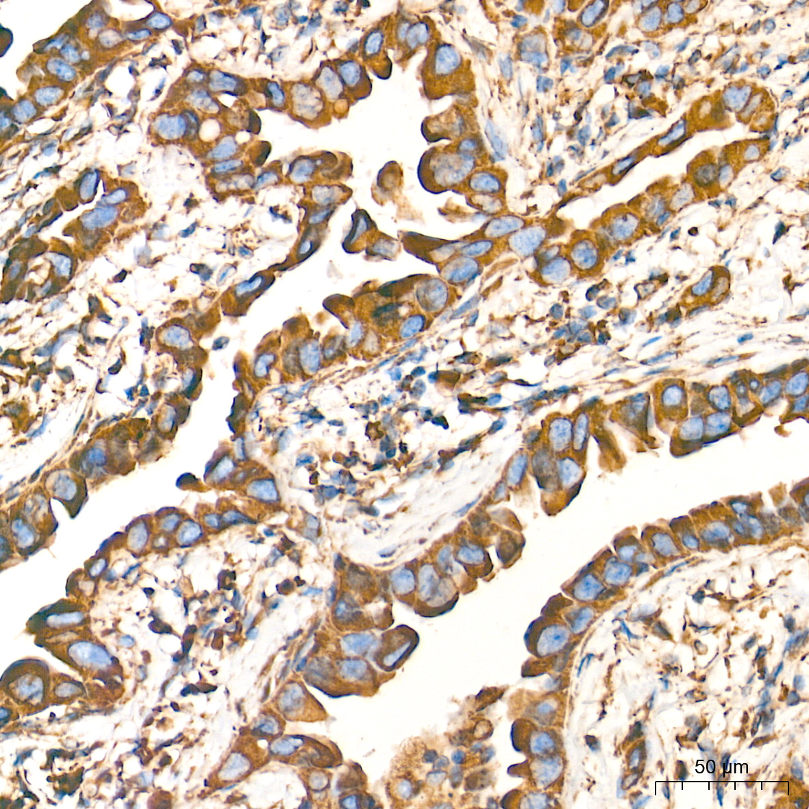 A0692PM, иммуногистохимия, ткань рака легкого человека (1228)