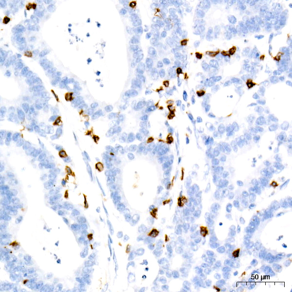 A9560, иммуногистохимия, карцинома толстой кишки человека (27725)
