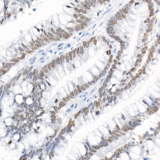 A2534, иммуногистохимия, карцинома толстой кишки человека (9333)