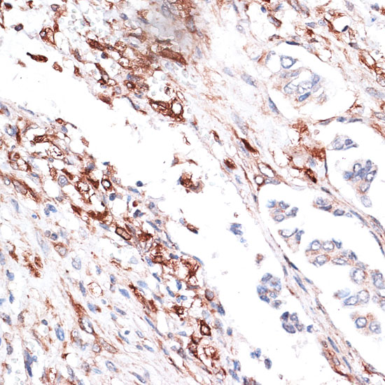 A2584, иммуногистохимия, парафиновые срезы ткани рака легкого человека (20727)