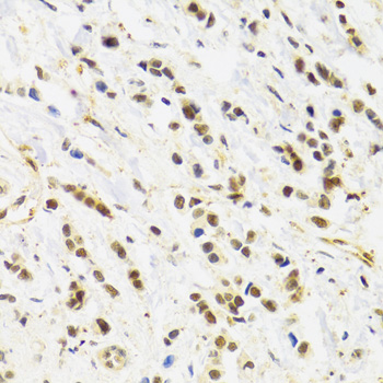 A0182, иммуногистохимия, парафиновые срезы ткани рака молочной железы человека (901)