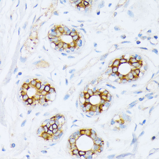 A0461, иммуногистохимия, парафиновые срезы ткани рака молочной железы человека (1202)